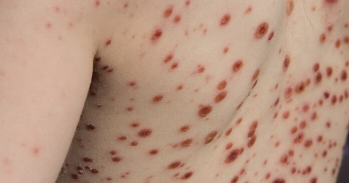 mpf-abre-inquerito-para-apurar-insuficiencia-de-repasses-da-vacina-contra-catapora-na-bahia