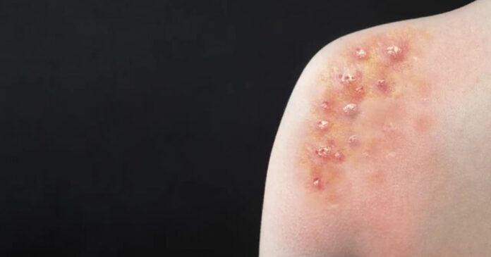 bahia-registra-38-casos-de-mpox-em-2024;-cerca-de-21-dos-pacientes-infectados-moram-em-salvador