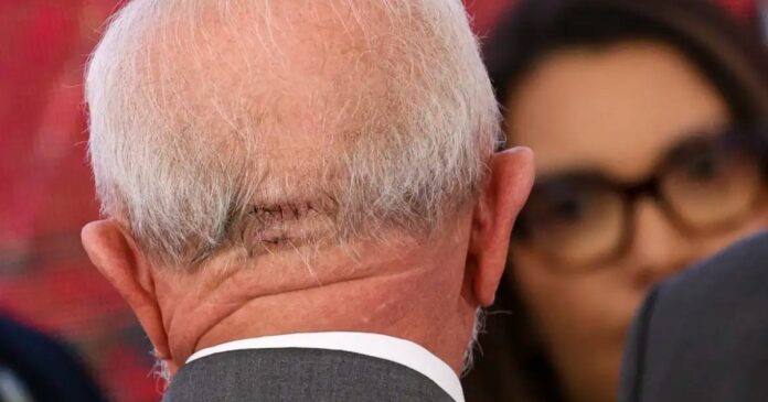 lula-aparece-com-pontos-na-cabeca-e-realiza-1a-agenda-apos-acidente-domestico