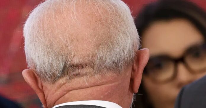 lula-faz-cirurgia-de-emergencia-em-sao-paulo-apos-sentir-dor-na-cabeca