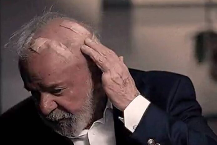 lula-mostra-curativos-na-cabeca-apos-cirurgias-de-emergencia-em-sp