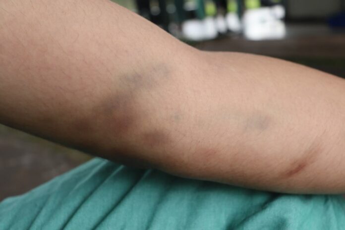 hospital-psiquiatrico:-fotografias-mostram-hematomas-em-paciente-morta