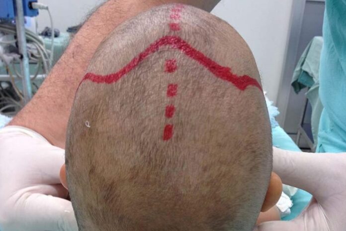 bebe-com-doenca-rara-consegue-cirurgia-de-r$-500-mil-pelo-sus