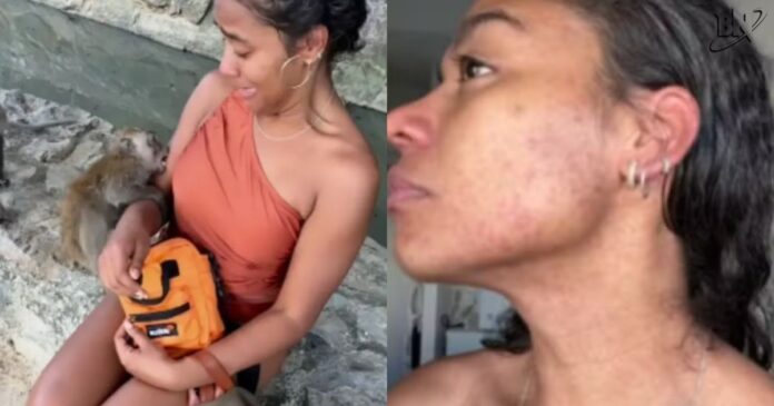 influenciadora-baiana-mordida-por-macaco-antecipa-volta-ao-brasil-apos-reacao-alergica-a-vacina