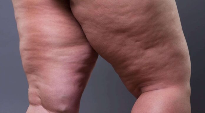 por-que-o-lipedema-e-mais-comum-em-mulheres?-entenda-sobre-a-doenca-de-yasmin-brunet