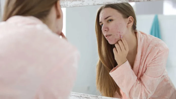 cicatrizes-de-acne,-como-amenizar-e-tratar?