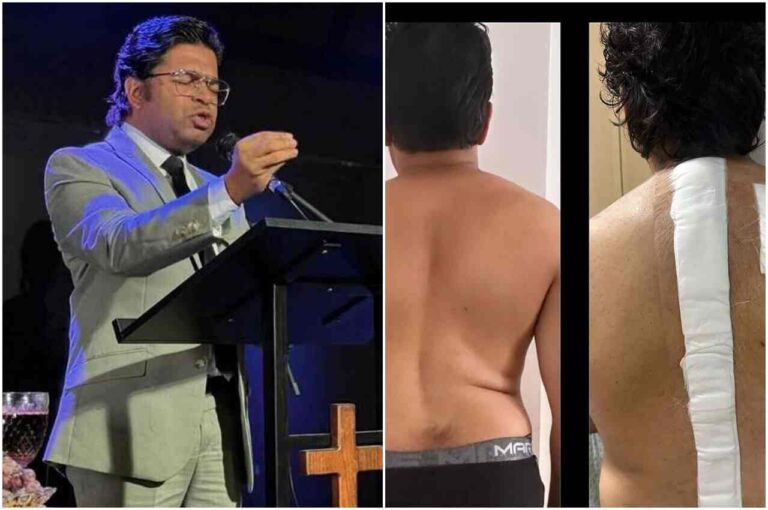 impactante:-veja-o-antes-e-o-depois-da-cirurgia-do-pastor-nilson-gomes