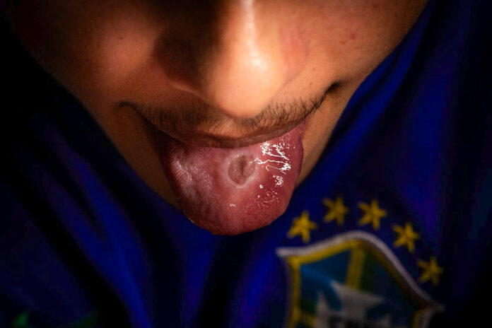 vitima-de-pais-de-santo-teve-lingua-e-maos-queimadas-com-colher-quente
