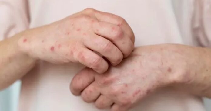 oms-alerta-para-aumento-de-casos-de-antraz-em-humanos-e-animais