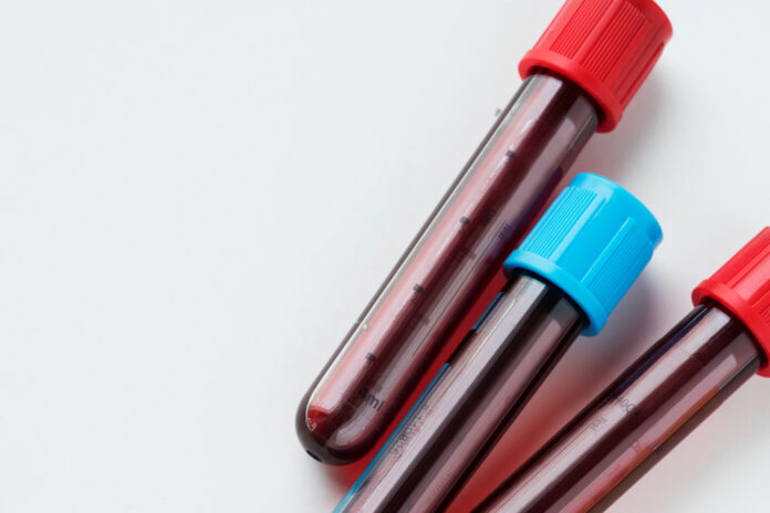 eua-aprovam-uso-de-exame-sanguineo-para-detectar-alzheimer