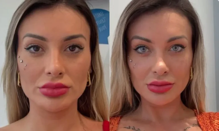 andressa-urach-passa-por-procedimento-e-surge-com-rosto-ensanguentado
