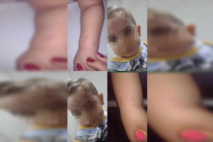 mae-denuncia-creche-apos-filho-chegar-em-casa-com-machucados.-veja