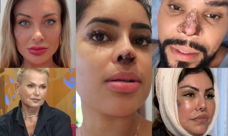 as-celebridades-que-quase-morreram-apos-procedimentos-esteticos