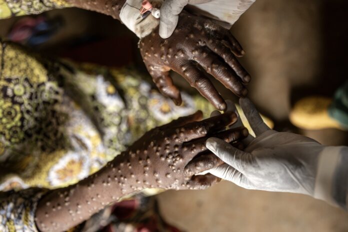 africa-registra-quase-50-mil-casos-de-mpox-confirmados