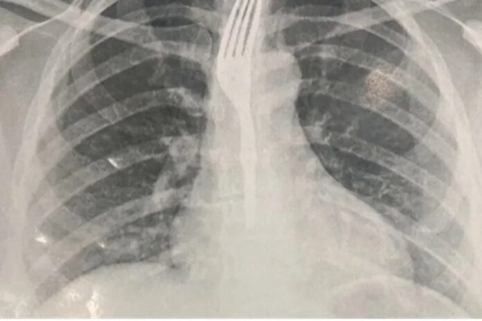 com-garfo-no-corpo,-mulher-e-internada-em-hospital-apos-engolir-utensilio-durante-refeicao-na-bahia