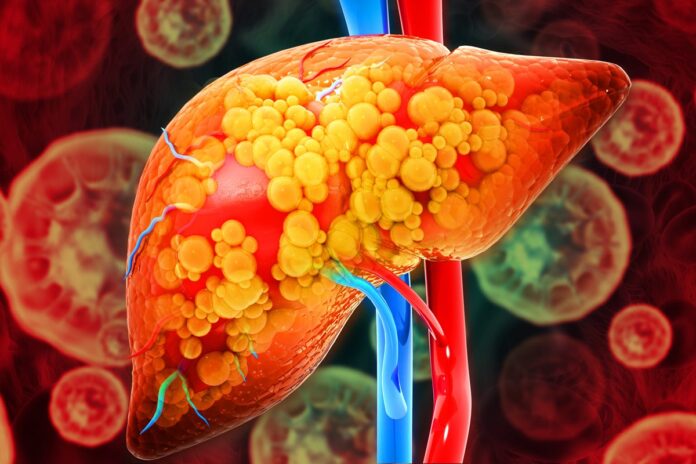 gordura-no-figado:-saiba-quais-sao-os-sintomas-da-esteatose-hepatica
