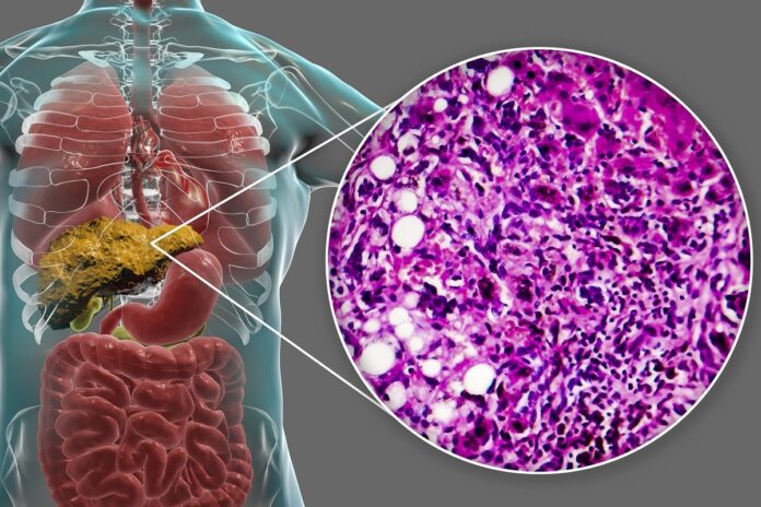 como-a-gordura-se-acumula-no-figado-e-onde-ela-se-instala-no-orgao