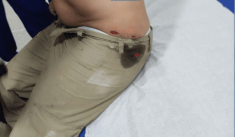 policial-militar-e-baleado-durante-operacao-em-nova-soure