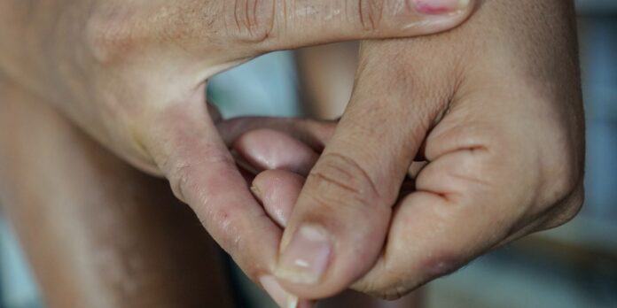 dermatite-atopica-compromete-pele,-sono-e-autoestima;-veja-como-tratar
