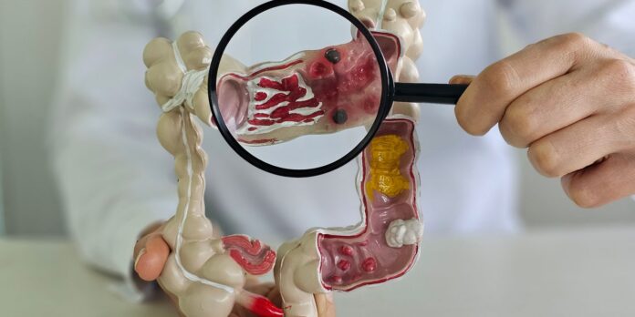 doenca-inflamatoria-intestinal-aumenta-cinco-vezes-no-brasil-em-13-anos