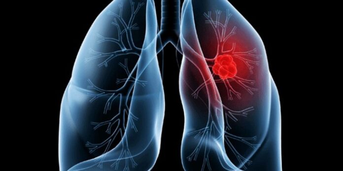 o-que-e-adenocarcinoma-pulmonar,-o-cancer-que-atinge-o-papa