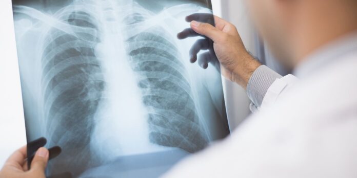 anvisa-aprova-farmaco-para-cancer-de-pulmao-em-estagio-avancado